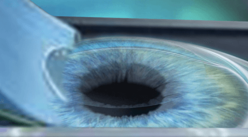 Lézeres szemműtét - OptiLASIK - lebeny fázis