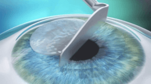Lézeres szemműtét - PRK - szaruhártya felső réteg eltávolítás - fázis
