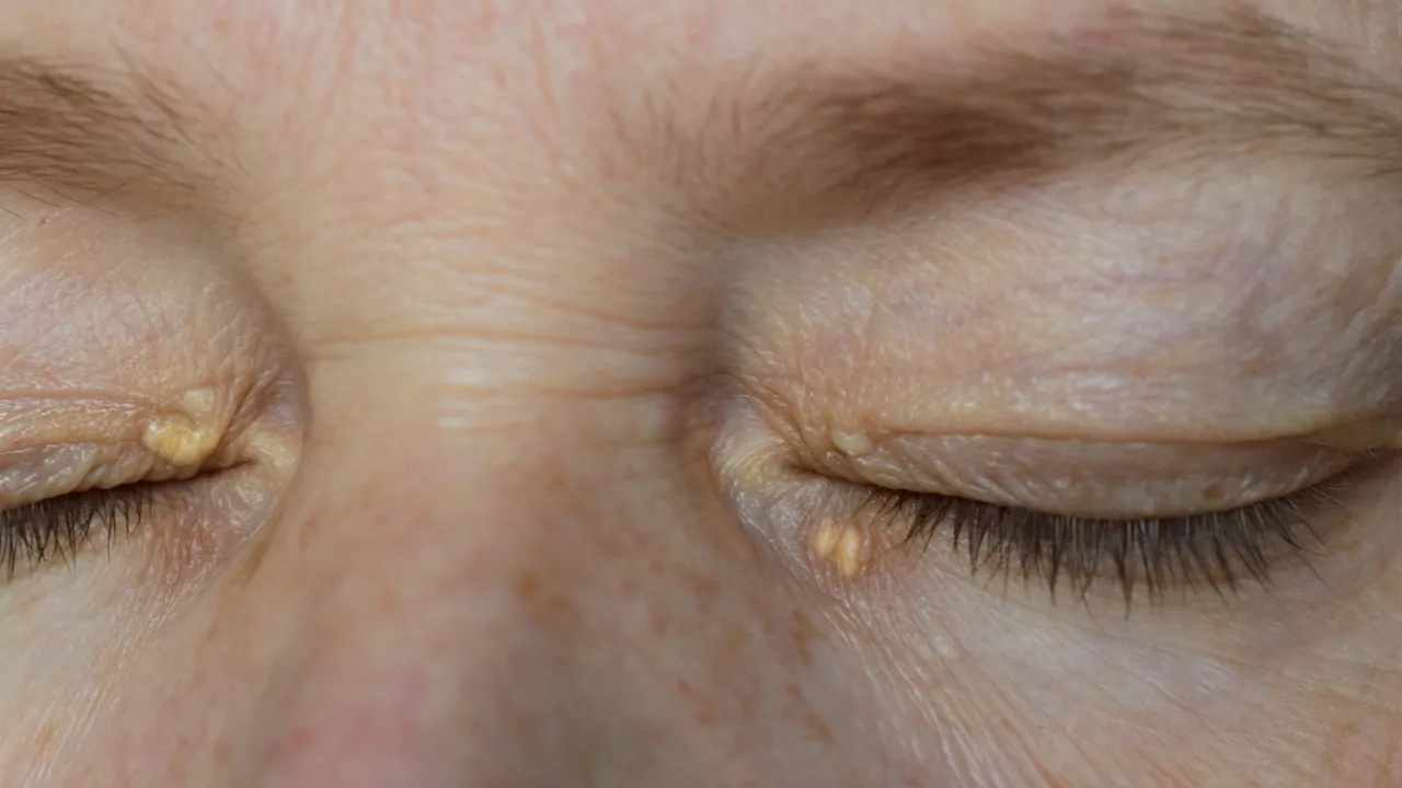 Xanthelasma eltávolítása - Xanthelasma műtét