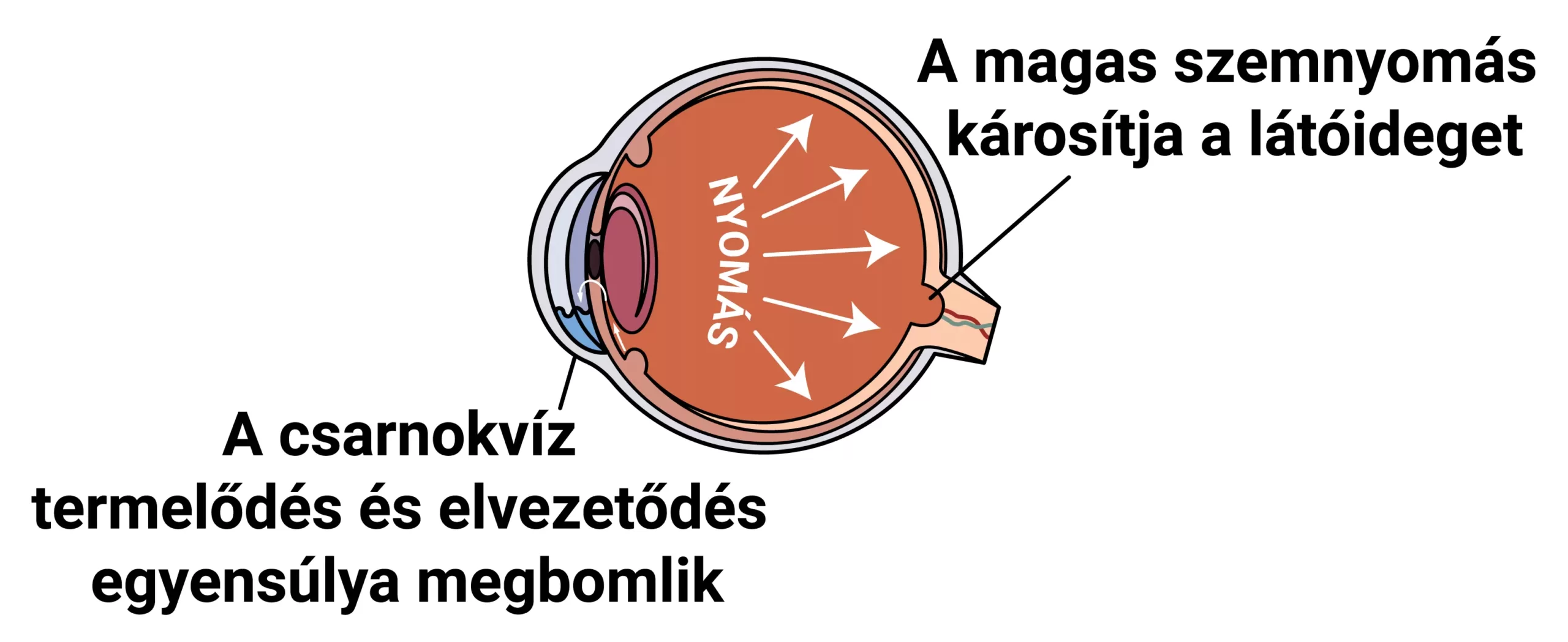 Budai Szemészeti Központ - zöldhályog - glaukóma - látóideg