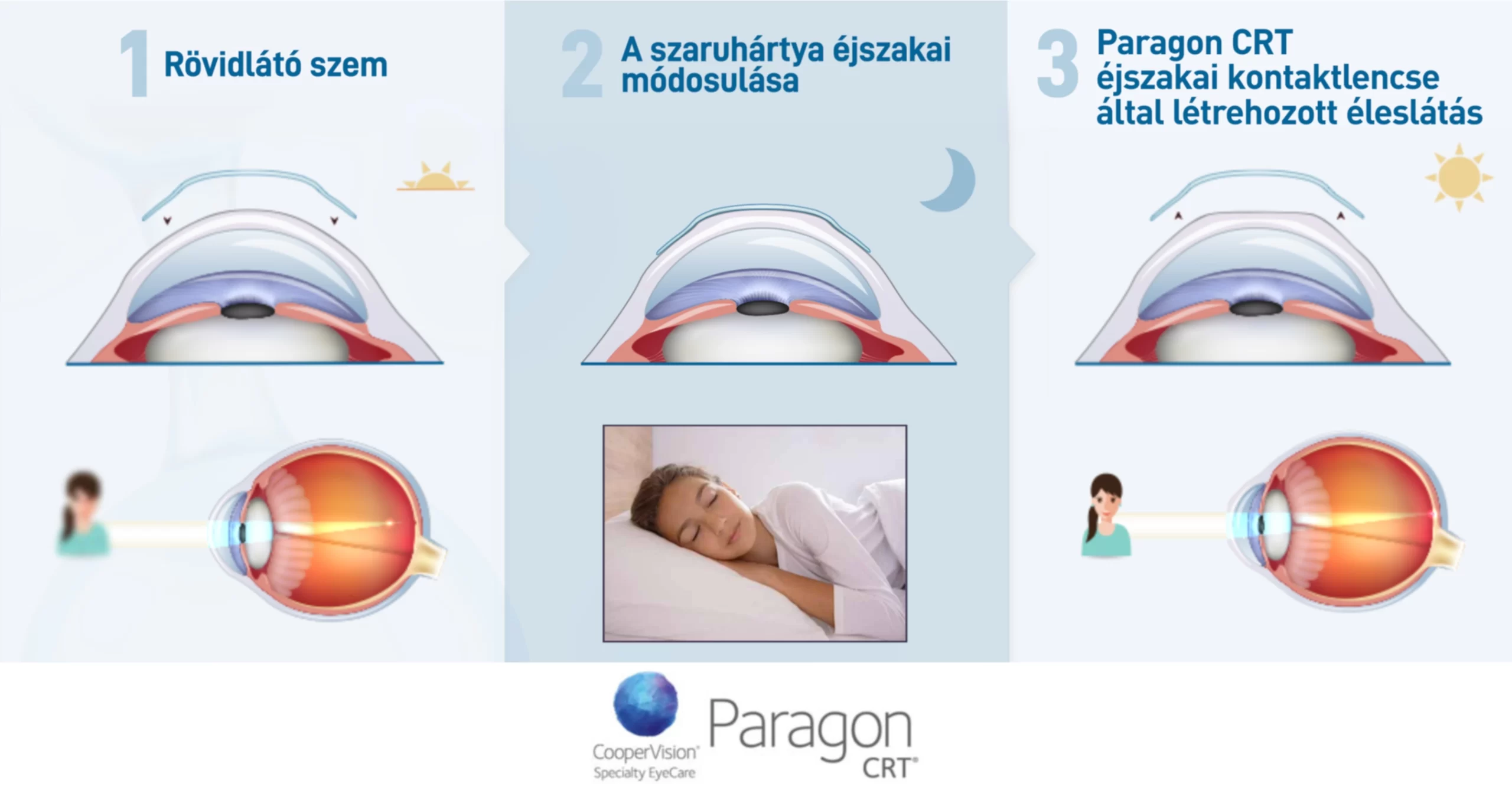 Éjszakai kontaktlencse - Ortokeratológiai lencse - szaruhártya formálás