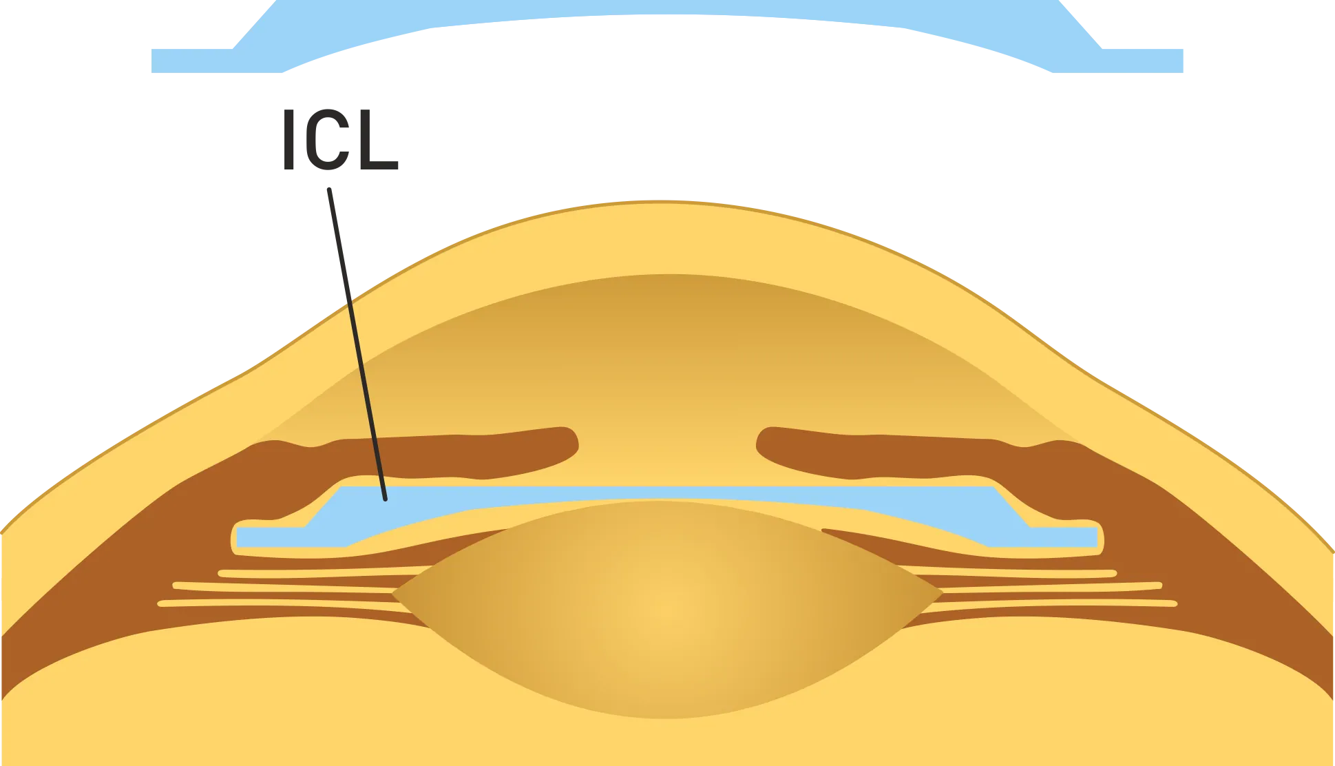 ICL - látásjavítás - vékony szaruhártya - szemen belüli kontaktlencse - Implantable Collamer Lens