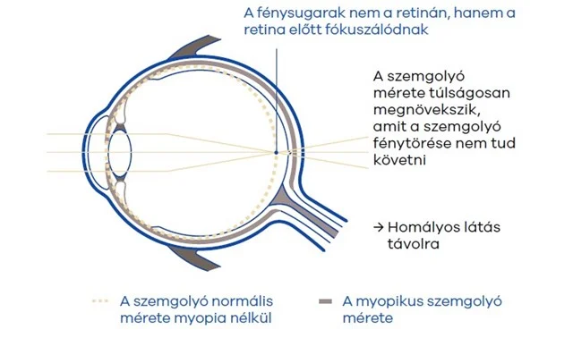 MIYOSMART szemüveg - miópia kontroll