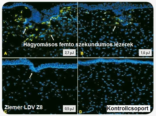 Ziemer Femto LDV Z8 - lézeres szemműtét - kíméletes lézeres kezelés