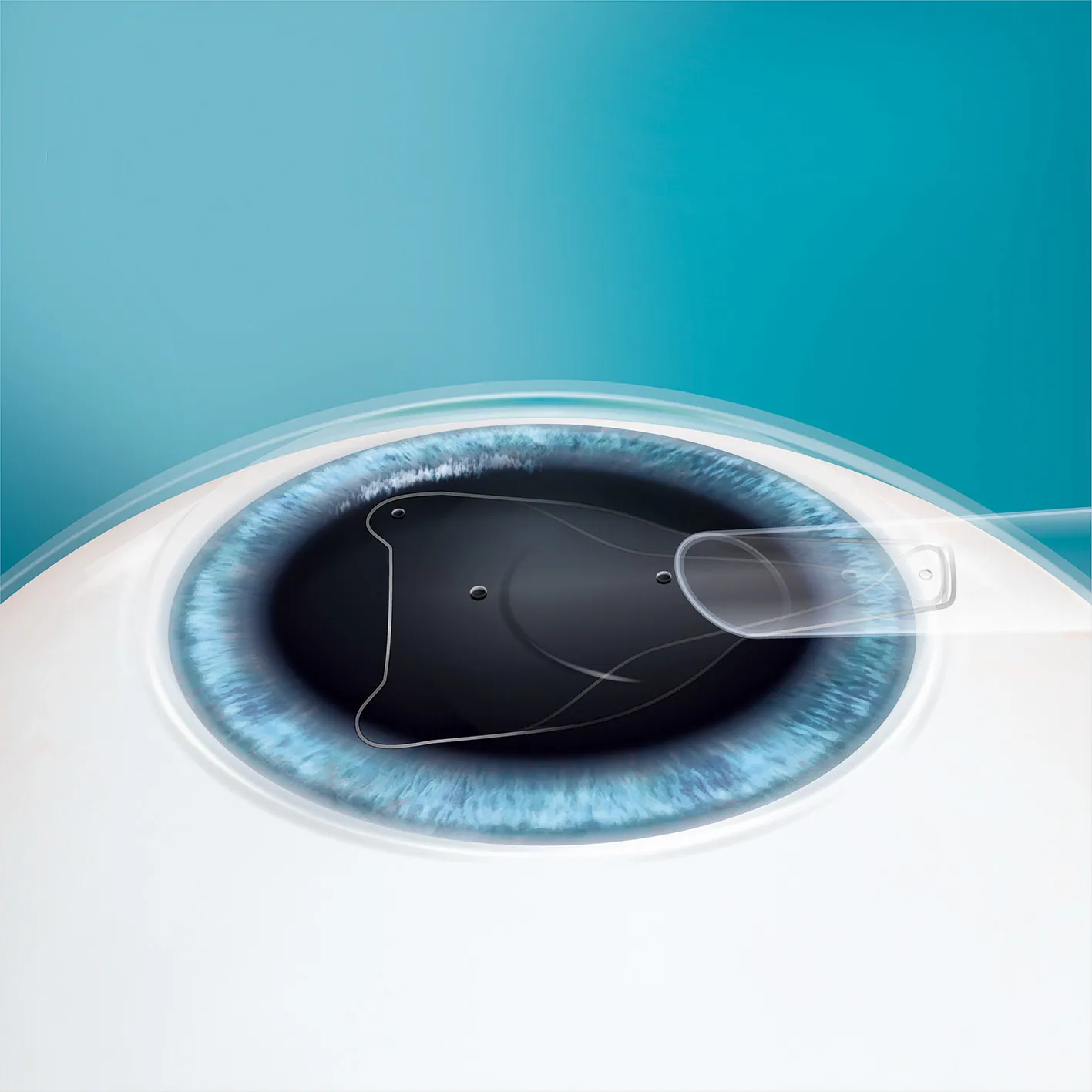 Staar Evo ICL lencse - látásjavítás - műlencse műtét - szemen belüli kontaktlencse - ICL behelyezés