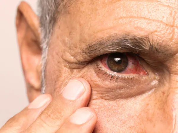 szem betegségei - kötőhárya-gyulladás - szembetegség - szemcsepp - szemszárazság - műkönny - kotohartyagyulladas