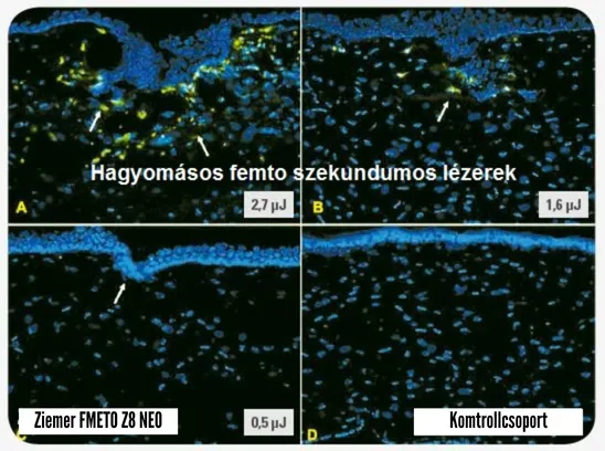 Ziemer Femto Neo Z8 - femtolézer - lézeres szemműtét - alacsony energia - minimális gyulladás