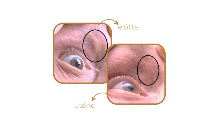 Xanthelasma - koleszterincsomó - Jett Plasma - plazmakezelés